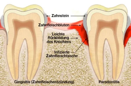 Zwei Zähne im Querschnitt mit den unterschiedlichen Schichten beschrieben